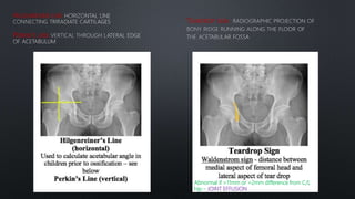 HILGENREINER LINE
PERKIN’S LINE
TEARDROP SIGN
Abnormal if >11mm or >2mm difference from C/L
hip – JOINT EFFUSION
 