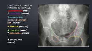 1.ILIOPECTINEAL
ILIOISCHIAL
3.ANTERIOR RIM
POSTERIOR
RIM
5.SHENTON
6.TEARDROP
OBTURATOR
SACRAL ARCS
 