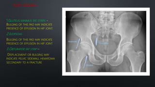 SOFT TISSUES
1.GLUTEUS MINIMUS FAT STRIPE
BULGING OF THIS PAD MAY INDICATE
PRESENCE OF EFFUSION IN HIP JOINT
2.ILIOPSOAS
BULGING OF THIS PAD MAY INDICATE
PRESENCE OF EFFUSION IN HIP JOINT
3.OBTURATOR FAT STRIP
DISPLACEMENT OR BULGING MAY
INDICATE PELVIC SIDEWALL HEMATOMA
SECONDARY TO A FRACTURE
 
