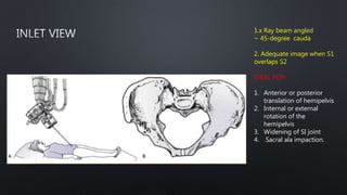 1.x Ray beam angled
~ 45-degree cauda
2. Adequate image when S1
overlaps S2
IDEAL FOR:
1. Anterior or posterior
translation of hemipelvis
2. Internal or external
rotation of the
hemipelvis
3. Widening of SI joint
4. Sacral ala impaction.
 