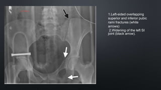 1.Left-sided overlapping
superior and inferior pubic
rami fractures (white
arrows)
2.Widening of the left SI
joint (black arrow).
 