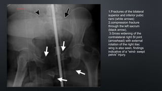 1.Fractures of the bilateral
superior and inferior pubic
rami (white arrows)
2.compression fracture
through the left sacrum
(black arrow),
3.Gross widening of the
contralateral right SI joint
(arrowhead) with external
rotation of the right iliac
wing is also seen, findings
indicative of a “wind- swept
pelvis” injury.
 