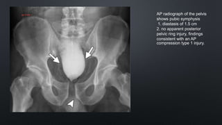 AP radiograph of the pelvis
shows pubic symphysis
1. diastasis of 1.5 cm
2. no apparent posterior
pelvic ring injury, findings
consistent with an AP
compression type 1 injury.
 