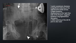 1.pubic symphysis diastasis
2.significant widening of the
right SI joint (white arrow)
3.slight posterior
displacement of the right iliac
side of the SI joint suggests
posterior ring ligamentous
disruption
4. Mild widening of the left SI
joint is also seen
 