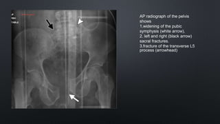 AP radiograph of the pelvis
shows
1.widening of the pubic
symphysis (white arrow),
2. left and right (black arrow)
sacral fractures.
3.fracture of the transverse L5
process (arrowhead)
 