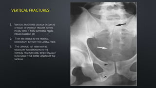 VERTICAL FRACTURES
1.
2.
3.
 