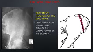 ILIAC WING FRACTURES
• DUVERNEY’S
FRACTURE OF THE
ILIAC WING.
•
 