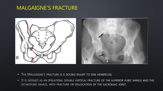 MALGAIGNE’S FRACTURE
•
•
 