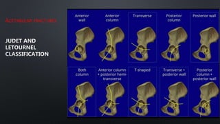 ACETABULAR FRACTURES
 