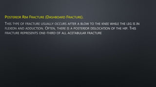 POSTERIOR RIM FRACTURE (DASHBOARD FRACTURE).
 