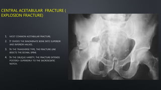 CENTRAL ACETABULAR FRACTURE (
EXPLOSION FRACTURE)
1.
2.
3.
4.
 