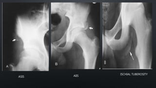 ASIS AIIS
ISCHIAL TUBEROSITY
 
