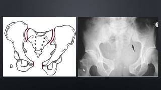 Pelvis fractures