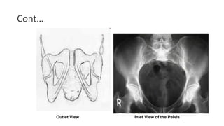 pelvis fractures corrected.pptx