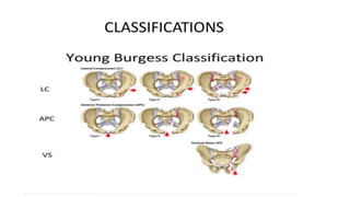 Lundborg's Classification pelvis fractures corrected.pptx