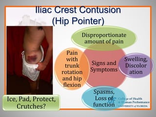 Iliac Crest Contusion
(Hip Pointer)
Signs and
Symptoms
Disproportionate
amount of pain
Swelling,
Discolor
ation
Spasms,
Loss of
function
Pain
with
trunk
rotation
and hip
flexion
Ice, Pad, Protect,
Crutches?
 