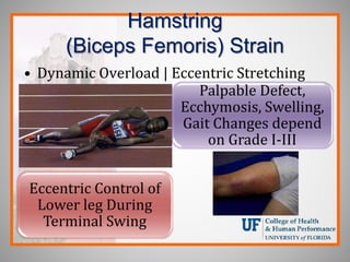 Hamstring
(Biceps Femoris) Strain
• Dynamic Overload | Eccentric Stretching
Palpable Defect,
Ecchymosis, Swelling,
Gait Changes depend
on Grade I-III
Eccentric Control of
Lower leg During
Terminal Swing
 