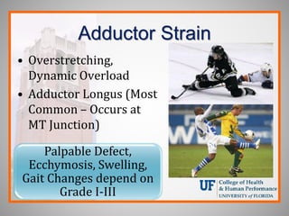 Adductor Strain
• Overstretching,
Dynamic Overload
• Adductor Longus (Most
Common – Occurs at
MT Junction)
Palpable Defect,
Ecchymosis, Swelling,
Gait Changes depend on
Grade I-III
 