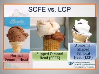SCFE vs. LCP
Normal
Femoral Head
Slipped Femoral
Head (SCFE)
Abnormal
Shaped
Femoral
Head (LCP)
 