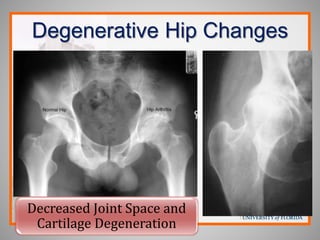 Degenerative Hip Changes
Decreased Joint Space and
Cartilage Degeneration
 