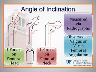 Angle of Inclination
Measured
via
Radiographs
Observed as
Valgus or
Varus
Femoral
Angulation
↑ Forces
on
Femoral
Head
↑ Forces
on
Femoral
Neck
 