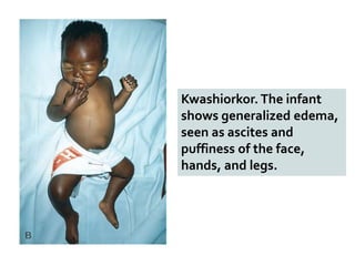 Kwashiorkor. The infant
shows generalized edema,
seen as ascites and
puffiness of the face,
hands, and legs.
 