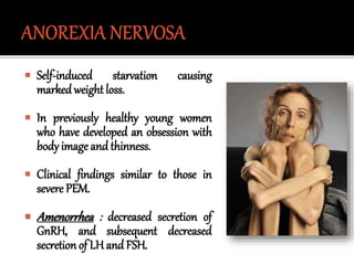  Self-induced starvation causing
marked weight loss.
 In previously healthy young women
who have developed an obsession with
body image and thinness.
 Clinical findings similar to those in
severe PEM.
 Amenorrhea : decreased secretion of
GnRH, and subsequent decreased
secretion of LH and FSH.
 