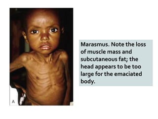 Marasmus. Note the loss
of muscle mass and
subcutaneous fat; the
head appears to be too
large for the emaciated
body.
 