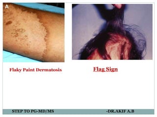 PDF The Nail Flag Sign Case Report in a Man with Diverticulitis and  Review of Dermatology Flag Sign of the Hair Skin and Nails  Semantic  Scholar