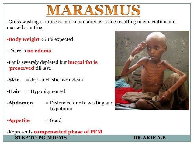 protein energy malnutrition protein energy malnutrition