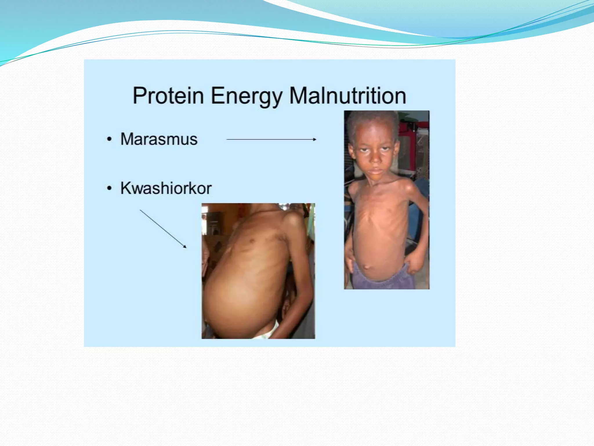 protein energy malnutrition | PPTX