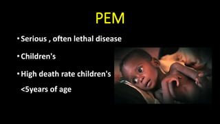 PEM
•Serious , often lethal disease
•Children's
•High death rate children's
<5years of age
 