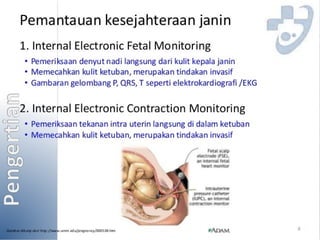 Pemantauan Janin, Partograf, Cardiotokografi PPT