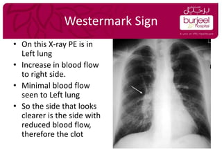 Westerback Sign Update on Pulmonary Embolism | PPTX