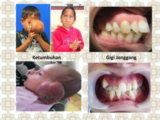 Ketumbuhan Gigi Jonggang
 