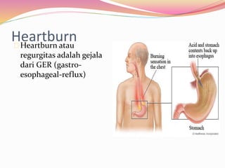Heartburn 
Heartburn atau 
regurgitas adalah gejala 
dari GER (gastro-esophageal- 
reflux) 
 