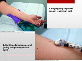 1. Pegang lengan pesakit
dengan tegangkan kulit
2. Suntik pada lapisan dermal
(siring hampir menyentuhi
kulit)
 