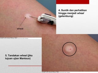 4. Suntik dan perhatikan
hingga menjadi wheal
(gelembung)
5. Tandakan wheal (jika
tujuan ujian Mantoux)
wheal
 