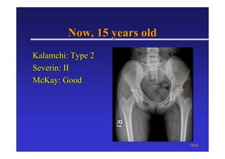 Pemberton Osteotomy in DDH.pdf