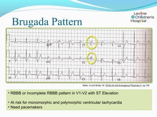 Brugada Pattern




                                          Mattu, A and Brady, W. ECGs for the Emergency Physician 2. p...