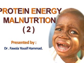PROTEIN ENERGY
MALNUTRTION
( 2 )
Presentedby :
Dr.FawziaYousifHammad.
 