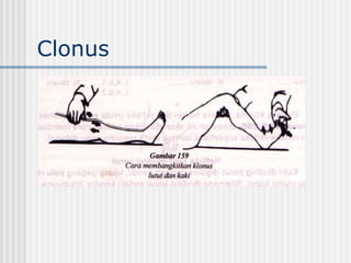Left Clonus Pemeriksaan Neurologis_1.ppt