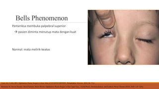 Pemeriksaan Palpebra.pptx