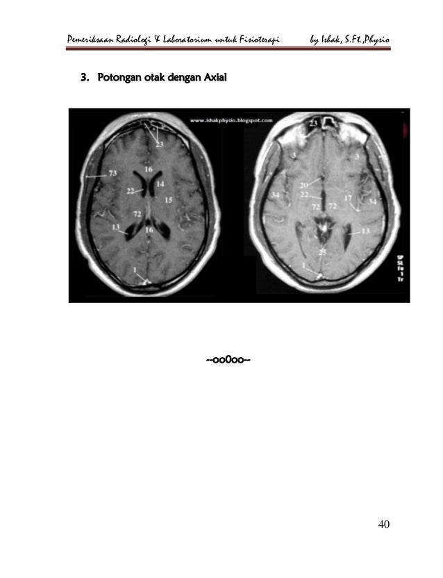 Sinusitis Fisioterapi