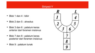 • Blok 1 dan 4 : bibir
• Blok 2 dan 5 : alveolus
• Blok 3 dan 6 : palatum keras
anterior dari foramen insisivus
• Blok 7 dan 8 : palatum keras
posterior dari foramen insisivus
• Blok 9 : palatum lunak
Striped-Y
 
