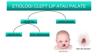 ETIOLOGI CLEFT LIP ATAU PALATE
GENETIK LINGKUNGAN
SINDROMA NON SINDROMA
 