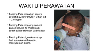 WAKTU PERAWATAN
• Feeding Plate dibuatkan segera
setelah bayi lahir (mulai 1-3 hari s.d
1-2 minggu)
• Feeding Plate dipasang sampai
pasien berusia 10 minggu o/k
sudah dapat dilakukan Labioplasty
• Feeding Plate digunakan setiap
hari terutama saat makan,
menyusu dan bicara.
 