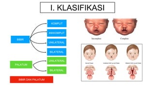 I. KLASIFIKASI
BIBIR
BIBIR DAN PALATUM
KOMPLIT
INKKOMPLIT
UNILATERAL
BILATERAL
PALATUM
UNILATERAL
BILATERAL
 