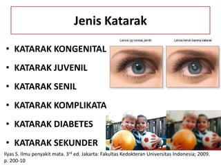 Jenis Katarak

• KATARAK KONGENITAL
• KATARAK JUVENIL
• KATARAK SENIL
• KATARAK KOMPLIKATA
• KATARAK DIABETES
• KATARAK SEKUNDER
Ilyas S. Ilmu penyakit mata. 3rd ed. Jakarta: Fakultas Kedokteran Universitas Indonesia; 2009.
p. 200-10
 