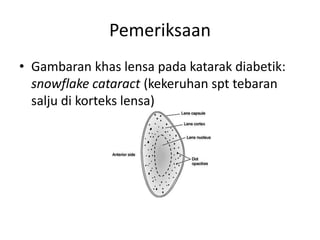 Pemeriksaan
• Gambaran khas lensa pada katarak diabetik:
  snowflake cataract (kekeruhan spt tebaran
  salju di korteks lensa)
 
